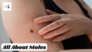 Moles