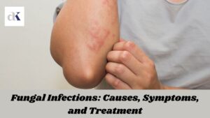 Fungal Infections