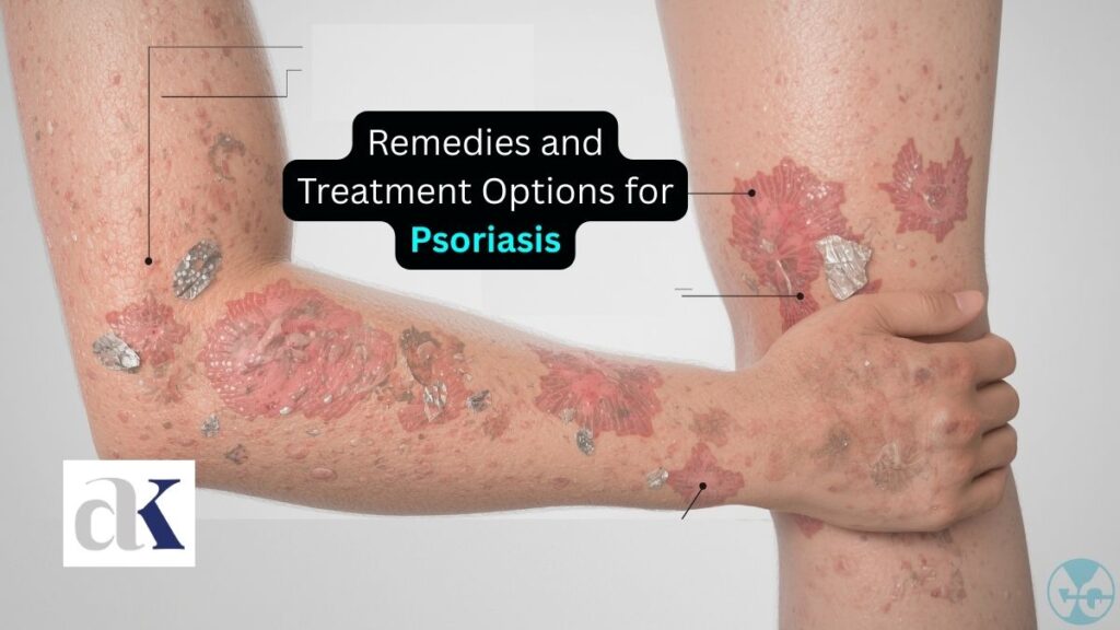 Remedies and Treatment Options for Psoriasis - best psoriasis doctor in indore