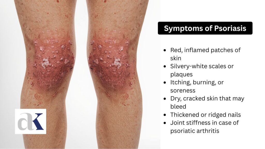 Symptoms of Psoriasis - best psoriasis doctor in indore