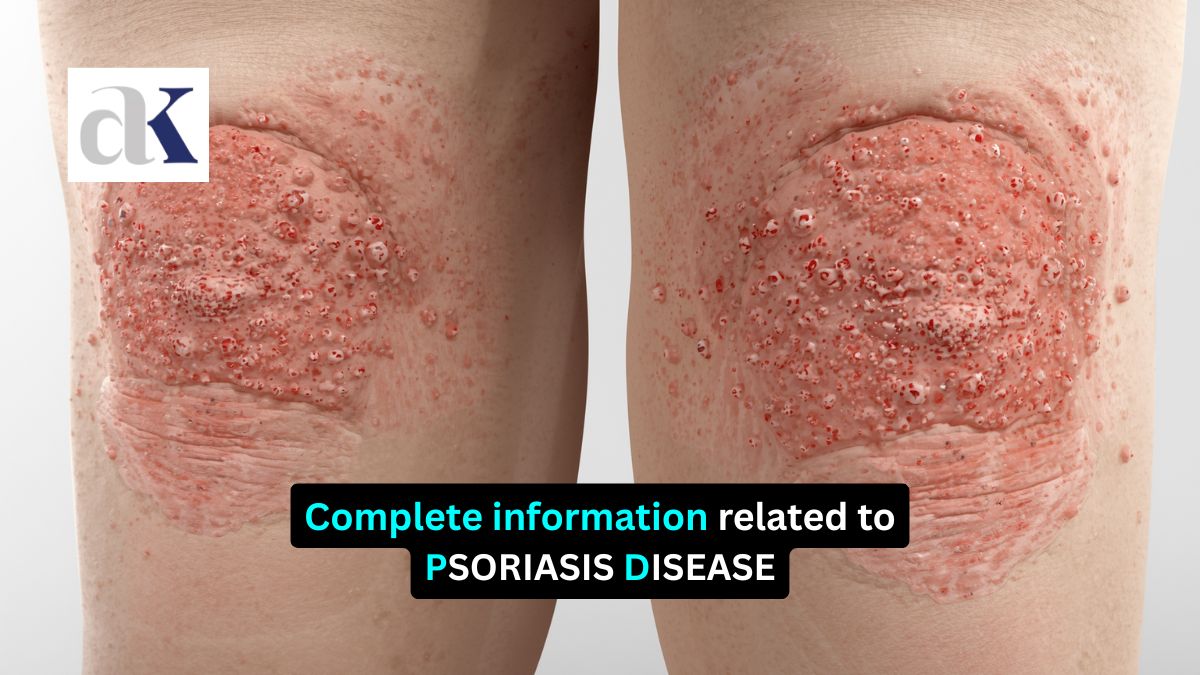 What is Psoriasis Full Information on Symptoms, Causes & Remedies - best psoriasis doctor in indore