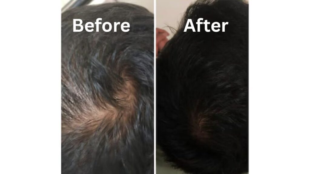 Why Choose the Best Hair Specialist in Indore for Exosome Therapy