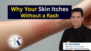 Why Your Skin Itches Without a Rash – Expert Insights from Itchy Skin Specialist Dr. Atul Kathed