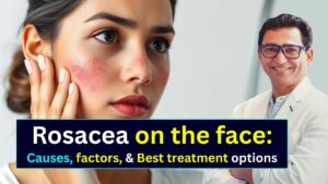 Rosacea on the face - Dermatologist Dr. Atul Kathed