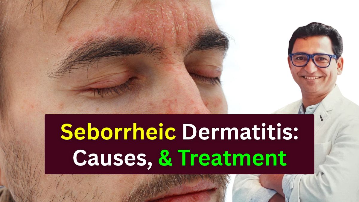 Seborrheic Dermatitis treatment in Indore - Dermatologist in Indoer Dr. Atul Kathed